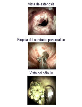 Imágenes intraductales del sistema SpyGlass DS