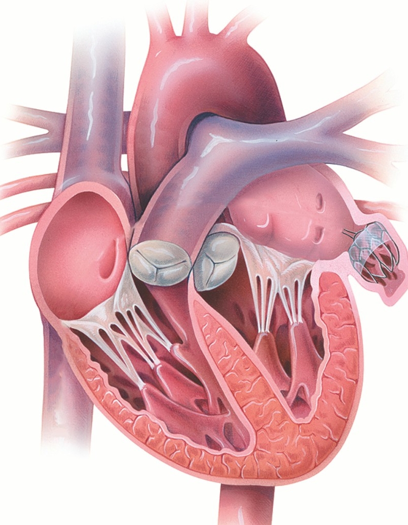 Ilustración del implante WATCHMAN en el corazón