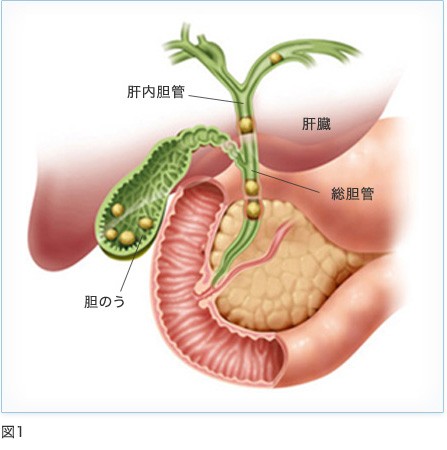 胆嚢 結石