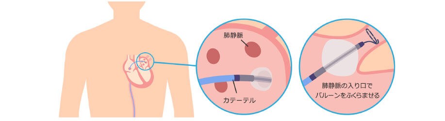 バルーンアブレーション治療