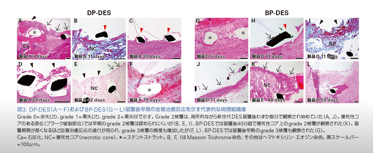 図3. DP-DES（A～F）およびBP-DES（G～L）留置後早期の血管治癒反応を示す代表的な病理組織像