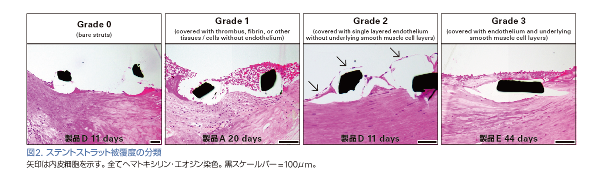 図2. ステントストラット被覆度の分類
