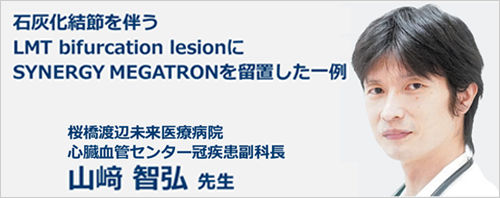 石灰化結節を伴うLMT bifurcation lesionに SYNERGY MEGATRONを留置した一例