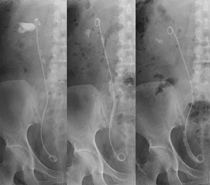 一塊の結石として残さなかったため ストーンストリートを形成し２度目のTULを要した症例