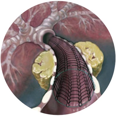 Ultraflex™  Tracheobronchial Stent System