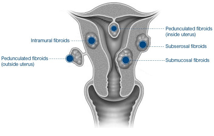 Miomas Anatomia