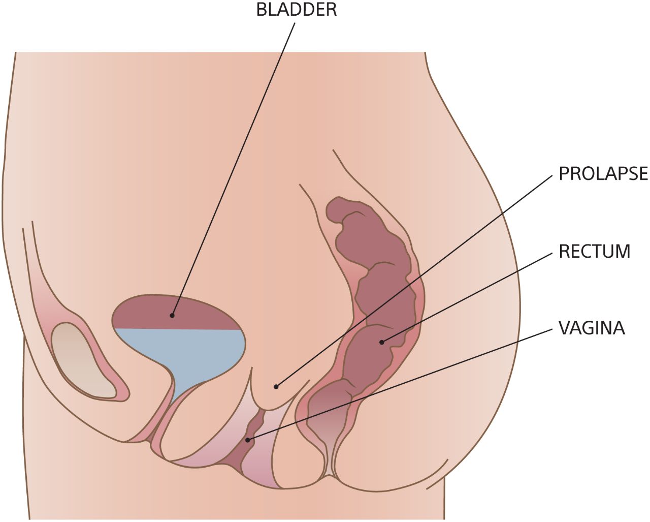 Prolapso Vaginal