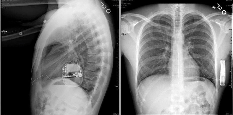 S-ICD chest x-ray post-implant