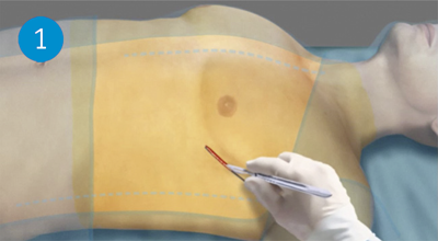 S-ICD implant incision