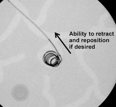 Interlock Fibered IDC Occlusion System Coil Retract and Reposition if desired
