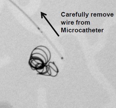 Interlock Fibered IDC Occlusion System Remove Wire from Microcatheter