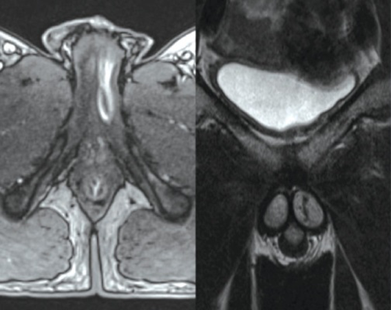 Case Study: Embolization for High-Flow Priapism