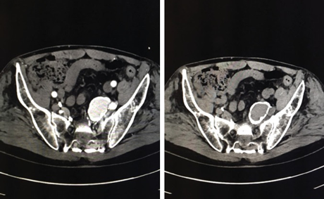 Coiling 6-cm Internal Iliac Artery Aneurysm