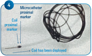 Coil Delivery 4