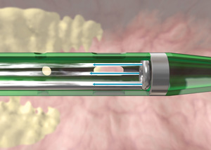 AngioJet Mechanism of Action