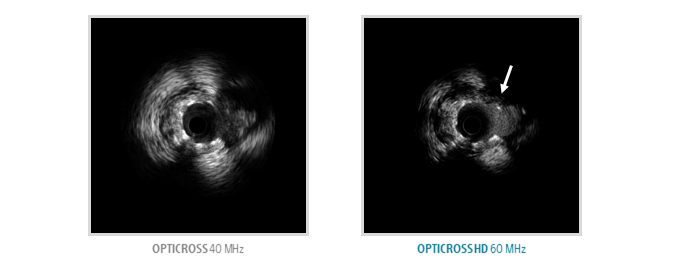 OPTICROSS 40MHz versus OPTICROSS HD 60MHz