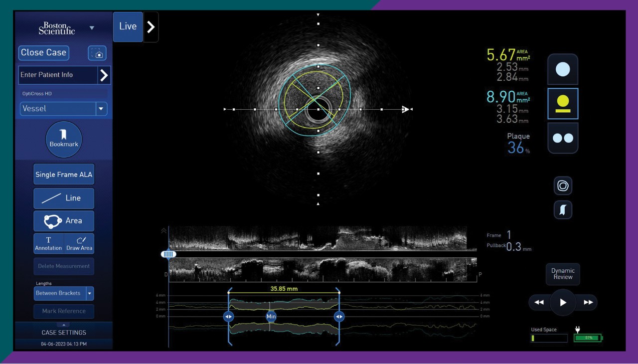 AVVIGO+ IVUS software
