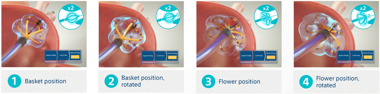 FARAPULSE dosing protocol illustration of application workflow.