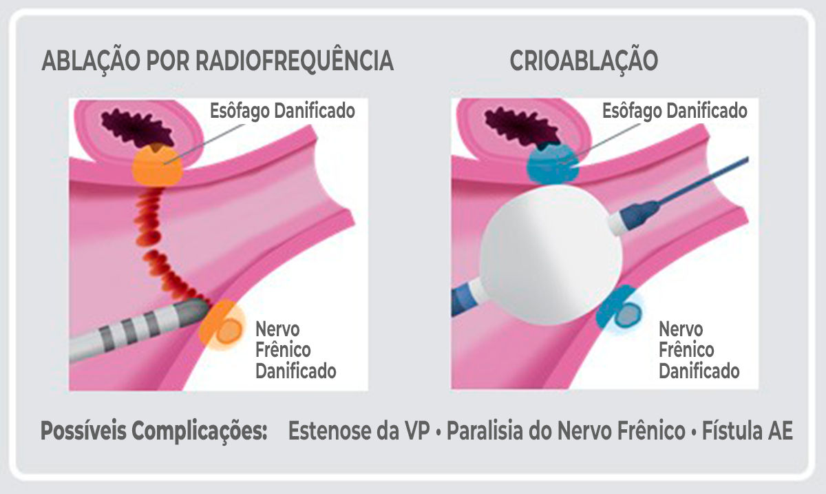 PFA Science and Tissue Labeled Illustration