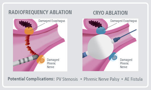 PFA Science and Tissue Labeled Illustration