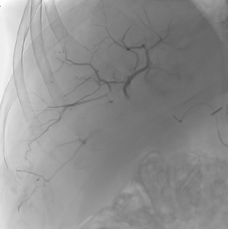 LC Bead LUMI: Middle of Injection