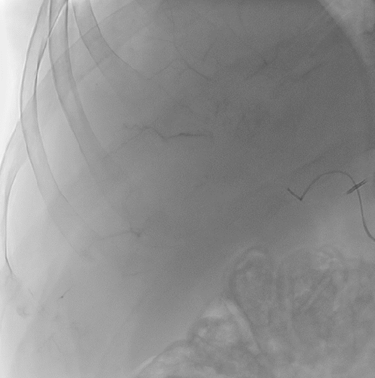 LC Bead LUMI: Beginning of Injection