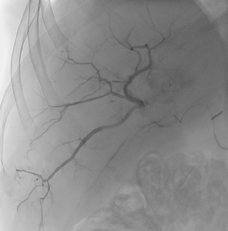LC Bead LUMI: End of Injection