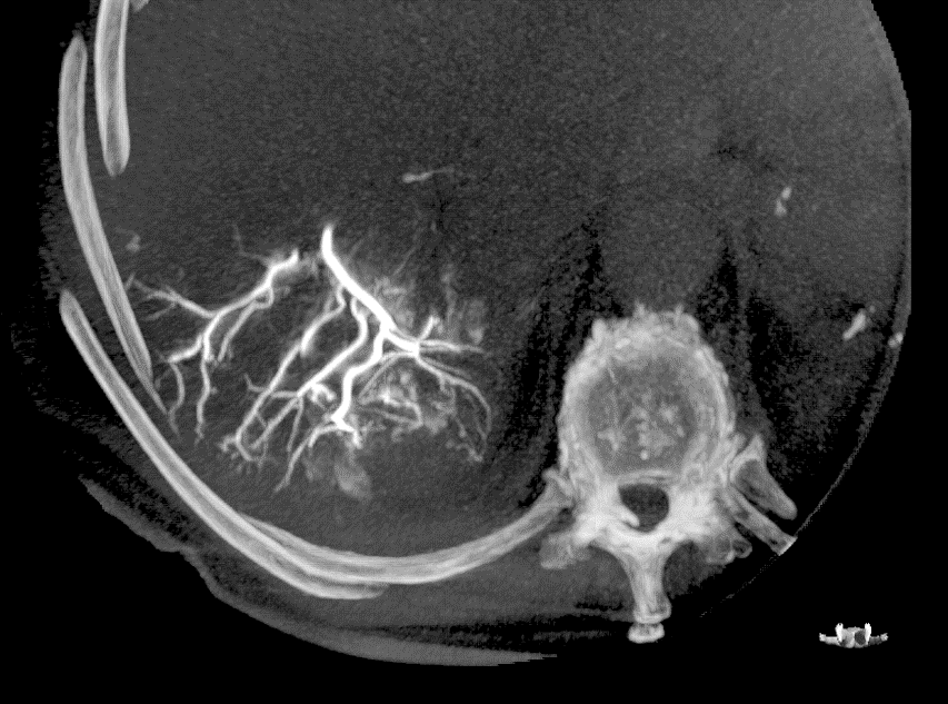 LC Bead LUMI: ACC; 4 weeks FU; CBCT MIP Axail plane