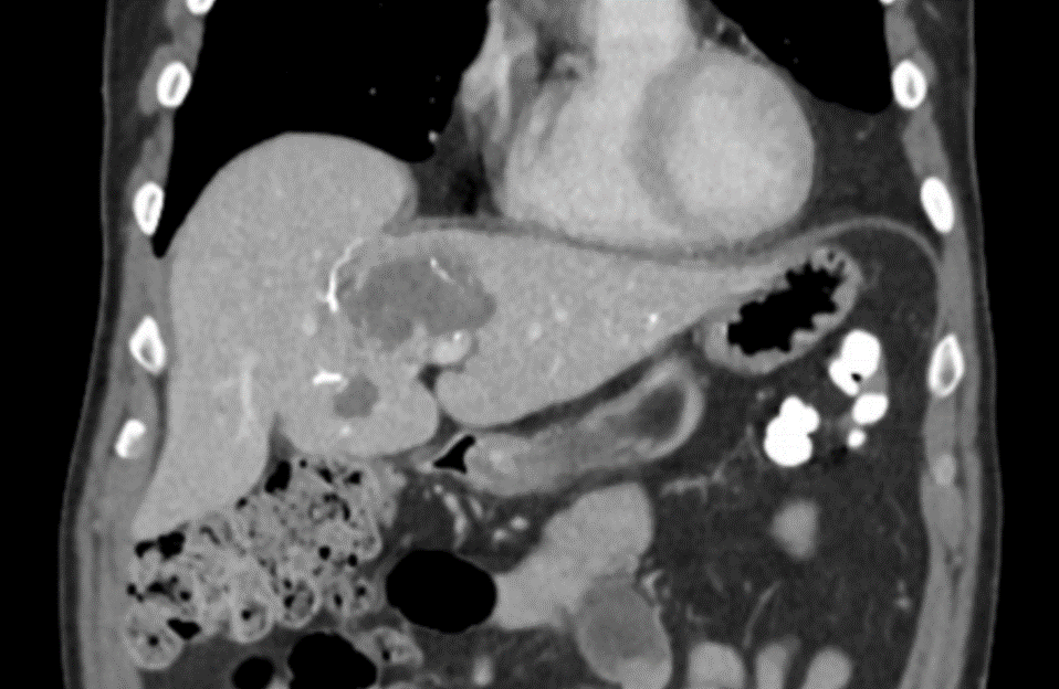 LC Bead LUMI: NET; 48h FU; MDCT Coronal Plane
