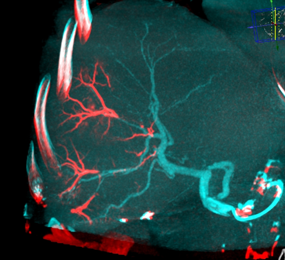 LC Bead LUMI: Embolized vessel clearly seen in red.
