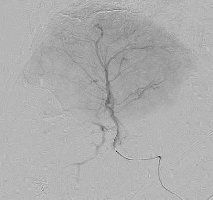 LC Bead LUMI: Shadowing artifact helps highlight treated regions.