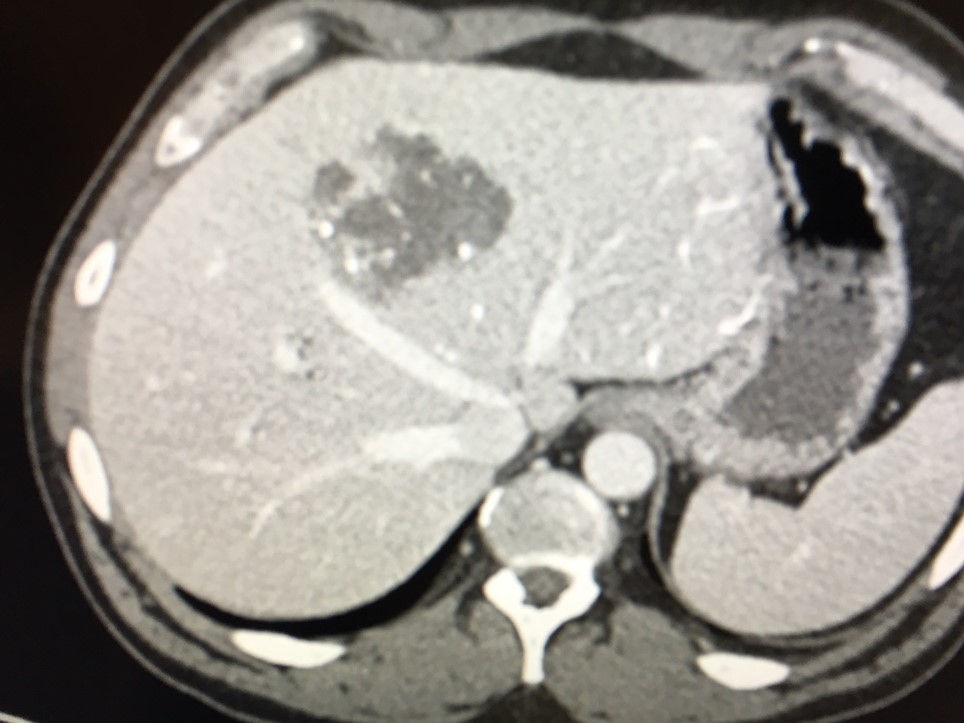 LC Bead LUMI: Showing area under treatment.
