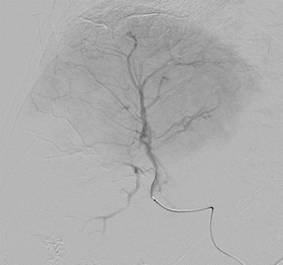 LC Bead LUMI: Shadowing artifact helps highlight treated regions.