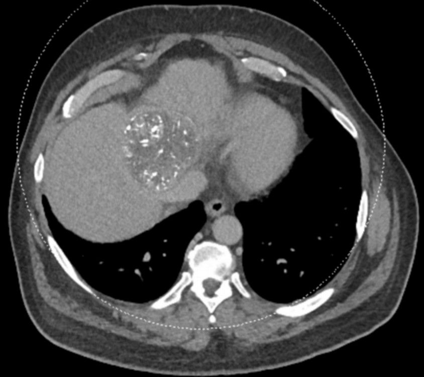 LC Bead LUMI: HCC; 48h FU; MDCT Axial plane