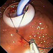 The Resolution Clip Device is used to grasp the suture for proper positioning of the tube in the jejunum 