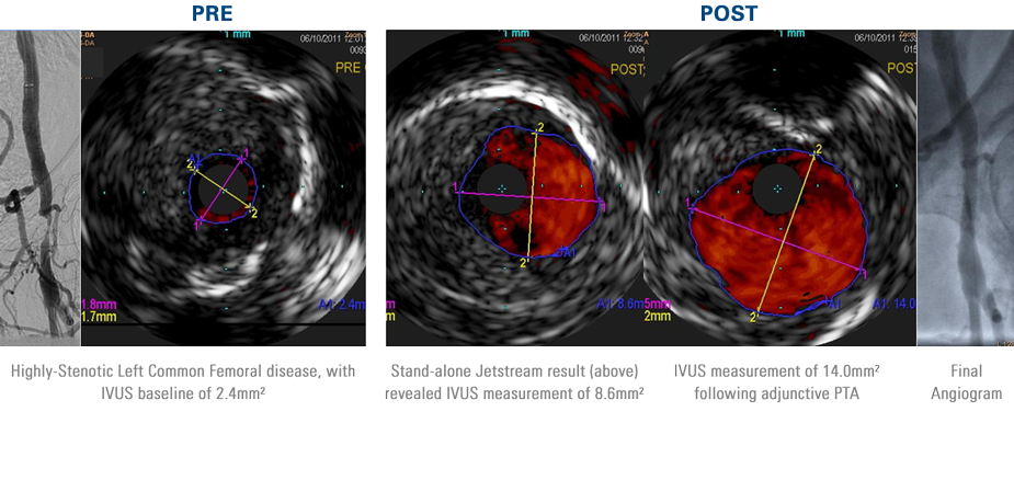 Pre-treatment angiogram and IVUS 