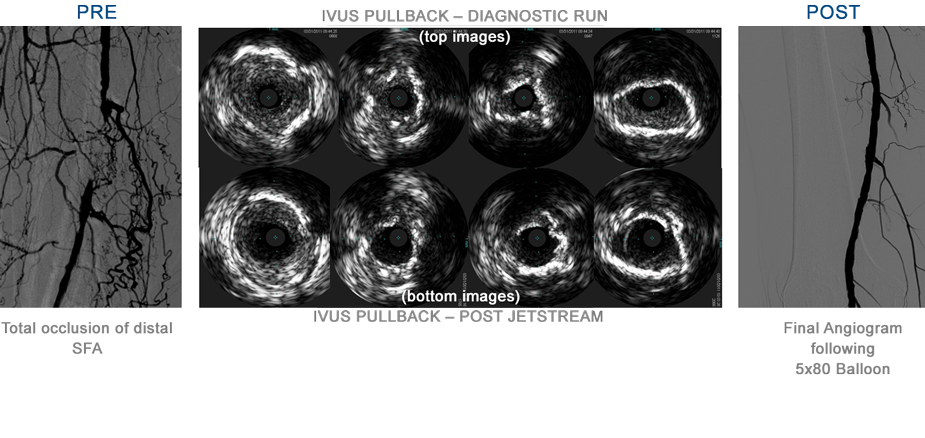 Pre-treatment angiogram and diagnostic run of IVUS images illustrated total occlusion of distal SFA. Post-treatment imaging demonstrated luminal gain (with no dissection) following Jetstream Atherectomy and PTA