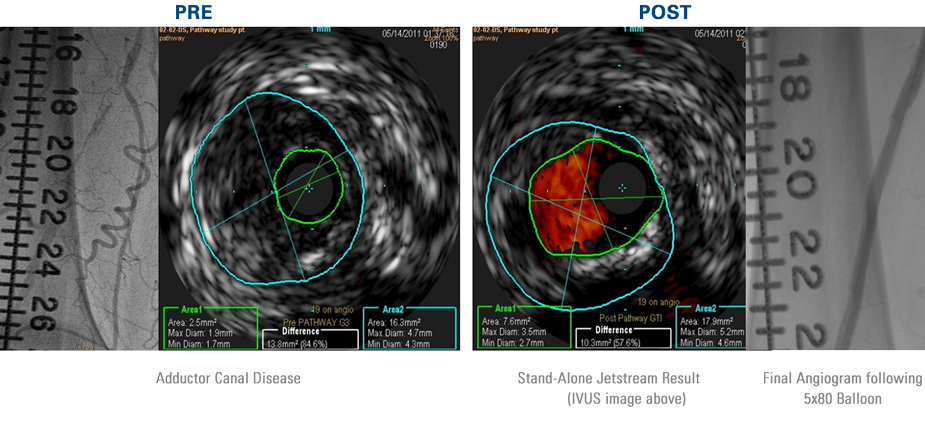 Pre-treatment angiogram and IVUS image illustrated Adductor Canal disease. IVUS image post-Jetstream Atherectomy revealed impressive luminal gain, prior to PTA with 5x80 balloon.
