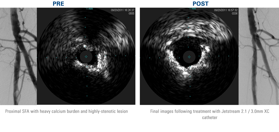 Pre-treatment angiogram and IVUS imaging illustrated heavy calcium burden and highly-stenotic lesion in proximal SFA. Post-treatment images revealed substantial calcium reduction and a concentric lumen following Jetstream Atherectomy.