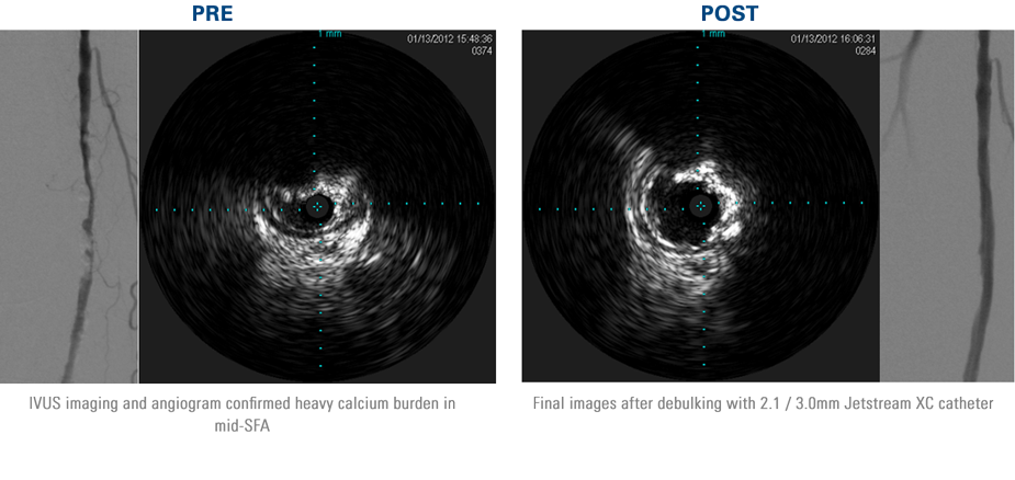Pre-treatment angiogram and IVUS imaging confirmed heavy calcium burden in mid-SFA. Post-treatment images revealed noticeable calcium reduction following Jetstream Atherectomy.