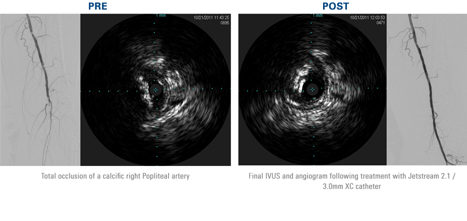 Pre-treatment angiogram and IVUS image illustrated a total occlusion of a calcific right Popliteal artery. Post-treatment images revealed calcium debulking, which produced a concentric lumen.