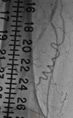 Jetstream Calcium Study: Image 1a (Angio): Pre-procedure CTO of right distal SFA/proximal popliteal