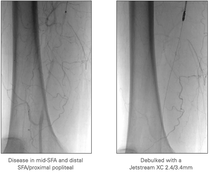 Vessel Prep with Jetstream