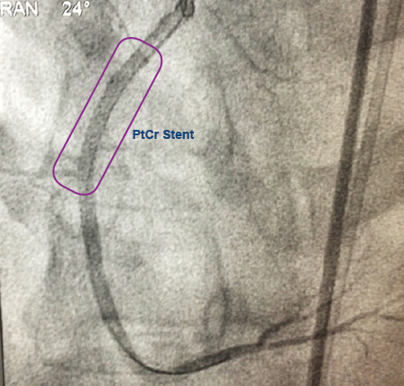 Stent de CrPt no Vaso