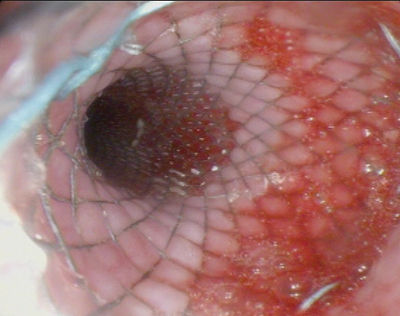 WallFlex Esophageal Stent